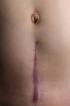 A recovering scar from a c-section operation.