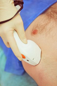 man receiving laser epilation at armpit on beauty center