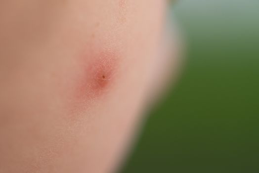A close up shot of a mosquito bite on a young boy's cheek