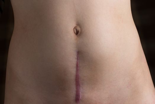 A recovering scar from a c-section operation.