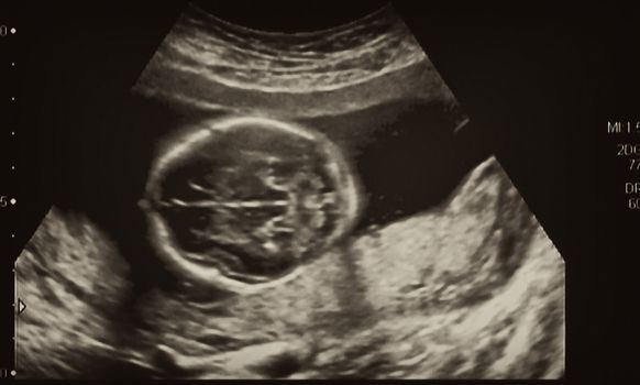 Ultrasonography Analysis of a 4th Month Fetus, Italy