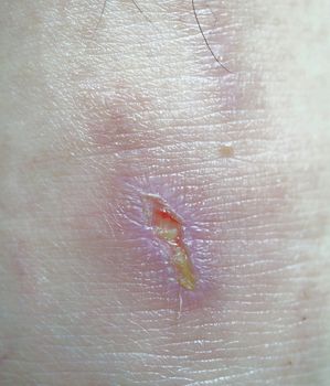 Leg wound, outside of the wound with pink color, inside covered with yellow tissue.                              