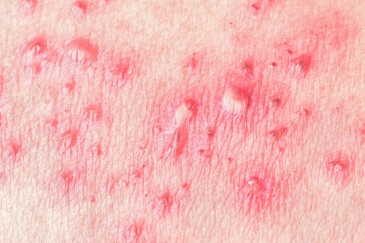 Detail of skin with Herpes Zoster (Shingles)