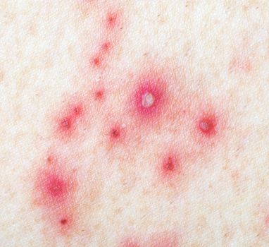 Detail of skin with Herpes Zoster (Shingles)