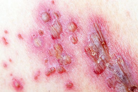 Detail of skin with Herpes Zoster (Shingles)