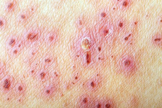 After treatment of skin with Herpes Zoster (Shingles)