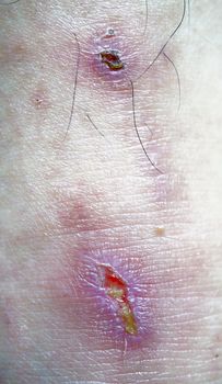 Wound or skin damage at lower leg, surrounding skin redness,                               