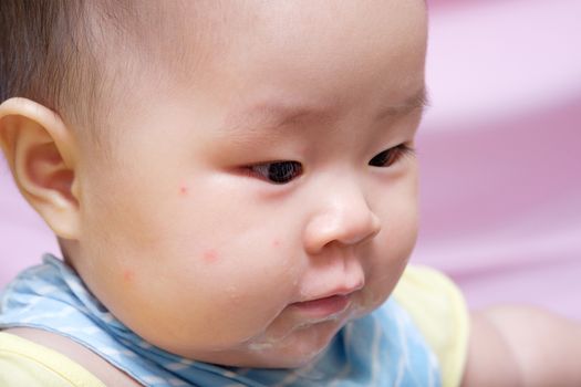 Asian thai baby girl with some red spot from mosquito bite on her cheek