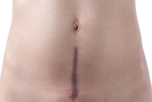 A woman's scar from a c-section birth on a white background.