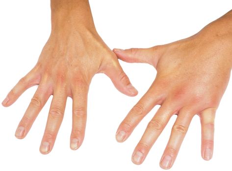 Comparing swollen male hands isolated towards white background