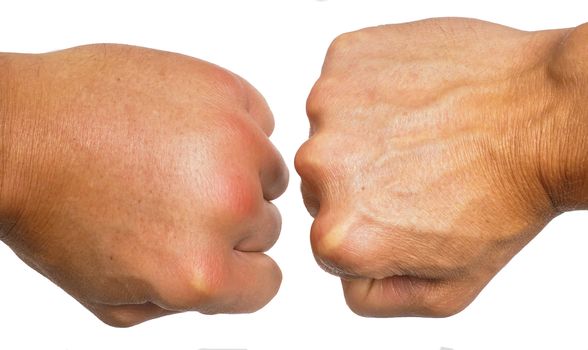 Comparing swollen male caucasian hands isolated towards white background