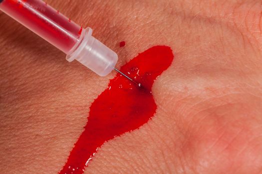 Subcutaneous medical injection concept with a small hypodermic syringe filled with a red liquid penetrating the skin and producing a flow of dripping blood in a close up view