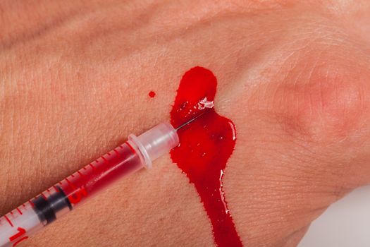 Subcutaneous medical injection concept with a small hypodermic syringe filled with a red liquid penetrating the skin and producing a flow of dripping blood in a close up view