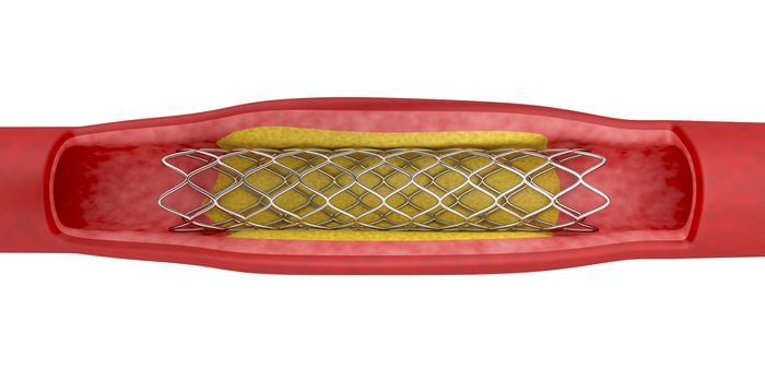 Angioplasty with stent placement, 3d illustration