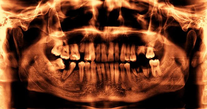 Panoramic dental x-ray image of teeth.