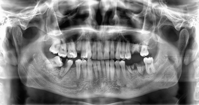 Original panoramic dental x-ray image of teeth.