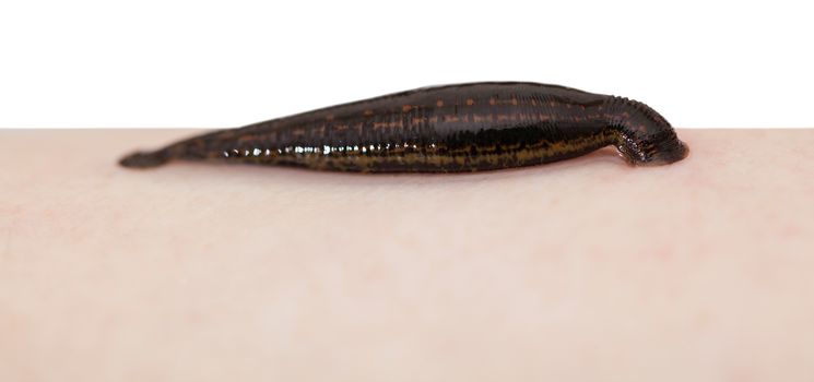 hirudotherapy, medical leech the suction blood of