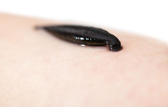 hirudotherapy, medical leech the suction blood of