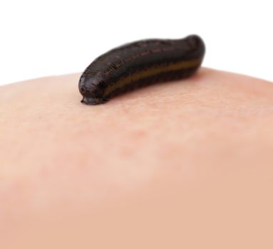 hirudotherapy, medical leech the suction blood of