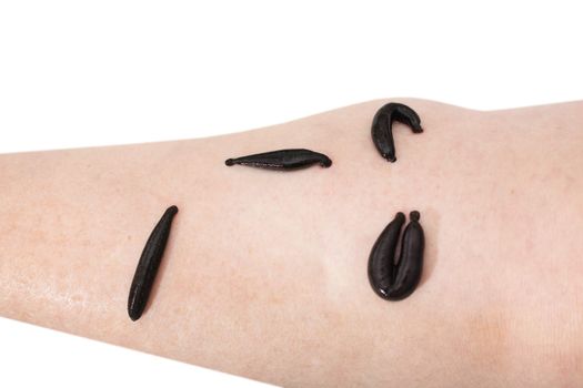 hirudotherapy, medical leech the suction blood of