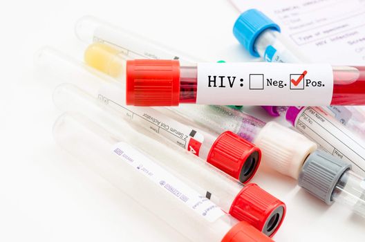 Sample blood collection tube with HIV test label on HIV infection screening test form.