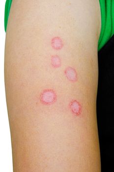 Microsporia a fungus on skin of arm human.
