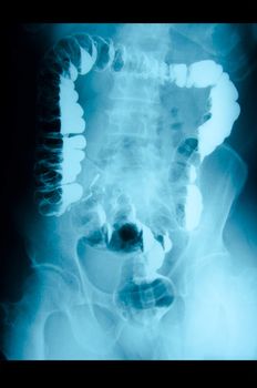 picture of intestinal abdominal xray