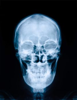 X-ray picture of the skull