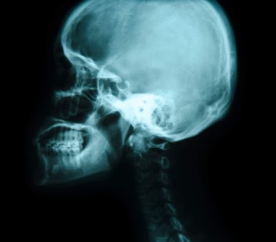 X-ray picture of the skull. Mouth close.