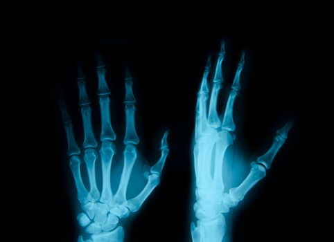 x-ray of hands on black background