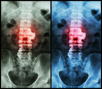 Spondylosis ( film x-ray lumbo - sacral spine : show spondylosis at L2-3 )