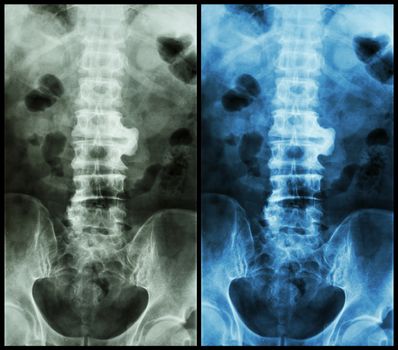 Spondylosis ( film x-ray lumbo - sacral spine : show spondylosis at L2-3 )