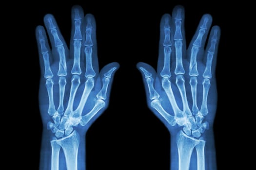 Fracture shaft of proximal phalange of ring finger ( film x-ray both hand AP )