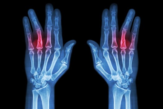 Fracture shaft of proximal phalange of ring finger ( film x-ray both hand AP )