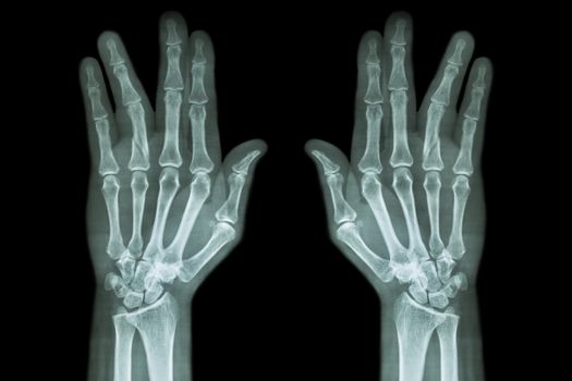 Fracture shaft of proximal phalange of ring finger ( film x-ray both hand AP )