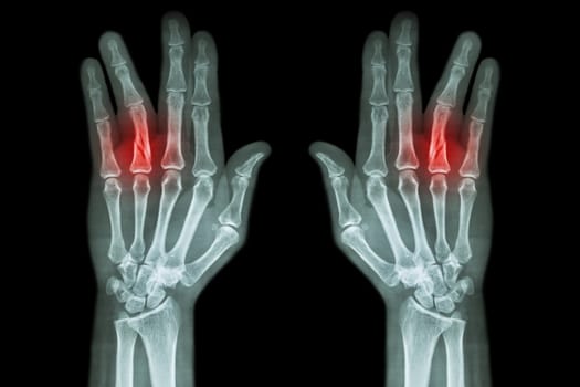 Fracture shaft of proximal phalange of ring finger ( film x-ray both hand AP )