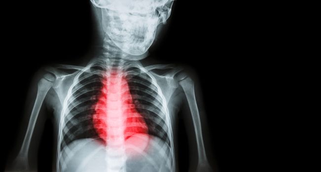 Ischemic Heart Disease , Myocardial Infarction ( MI ) ( Film x-ray body of human with heart disease and blank area at right side ) ( Cardiopulmonary resuscitate and Cardiovascular concept )