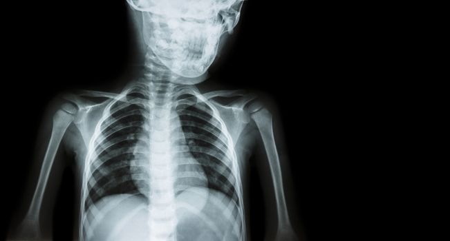 Film x-ray body of child and blank area at right side ( Medical background )