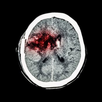 CT scan of brain : show old right basal ganglia hemorrhage with brain edema ( status post craniotomy ) ( Hemorrhagic stroke )