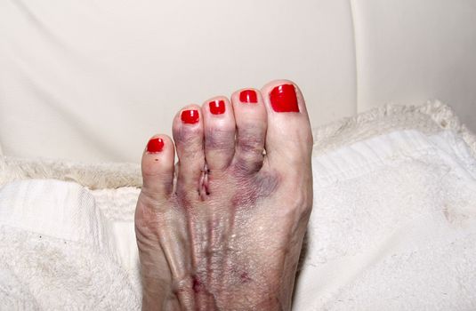 Foot after Morton’s neuroma surgery between the second and third toe.  After surgery, the bruised foot is wrapped and then placed in a protective boot.