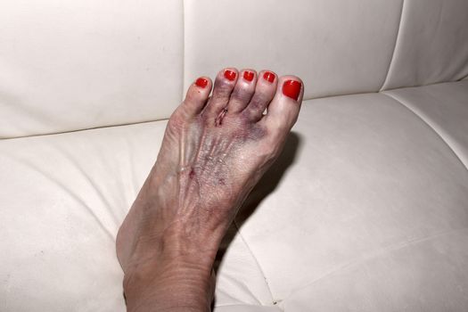 Foot after Morton’s neuroma surgery between the second and third toe.  After surgery, the bruised foot is wrapped and then placed in a protective boot.