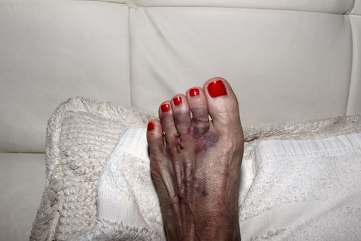 Foot after Morton’s neuroma surgery between the second and third toe.  After surgery, the bruised foot is wrapped and then placed in a protective boot.