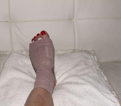 Foot after Morton’s neuroma surgery between the second and third toe.  After surgery, the bruised foot is wrapped and then placed in a protective boot.