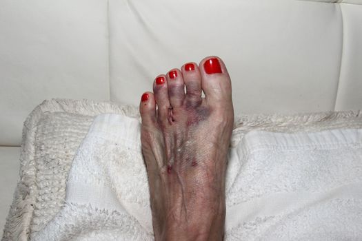 Foot after Morton’s neuroma surgery between the second and third toe.  After surgery, the bruised foot is wrapped and then placed in a protective boot.