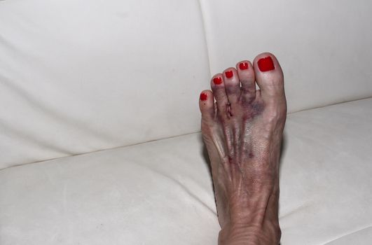 Foot after Morton’s neuroma surgery between the second and third toe.  After surgery, the bruised foot is wrapped and then placed in a protective boot.