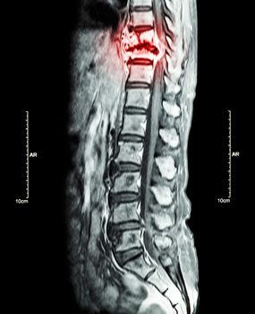 Spine metastasis ( cancer spread to thoracic spine ) ( MRI of thoracic and lumbar spine : show thoracic spine metastasis and compress spinal cord ( Myelopathy ) ) ( sagittal plane )