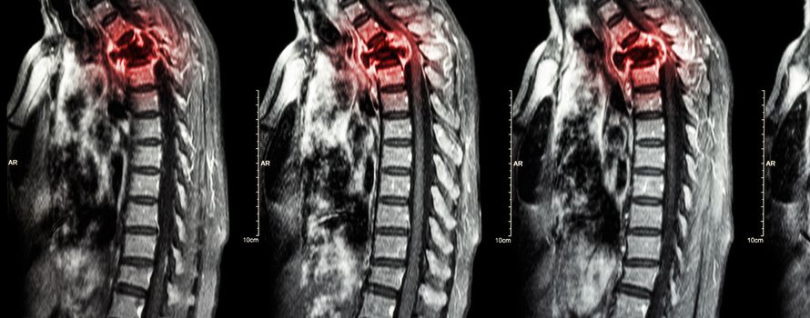 Spine metastasis ( cancer spread to thoracic spine ) ( MRI of cervical and thoracic spine : show thoracic spine metastasis and compress spinal cord ( Myelopathy ) ) ( sagittal plane )