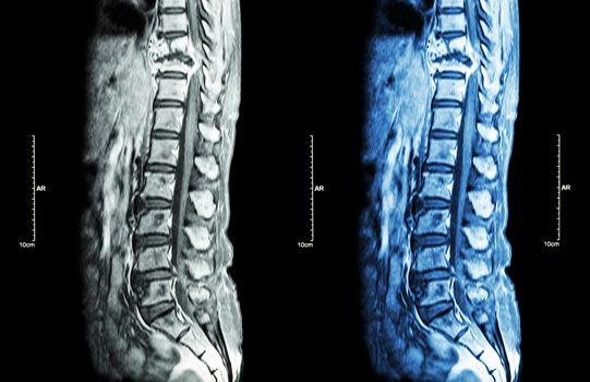 Spine metastasis ( cancer spread to thoracic spine ) ( MRI of thoracic and lumbar spine : show thoracic spine metastasis and compress spinal cord ( Myelopathy ) ) ( sagittal plane )