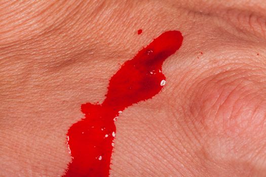 Subcutaneous medical injection concept with a small hypodermic syringe filled with a red liquid penetrating the skin and producing a flow of dripping blood in a close up view