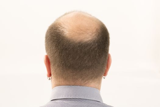 40s man with an incipient baldness , close-up, white background